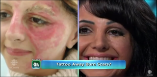Illustration for article titled This woman uses tattooing to cover her clients' scars